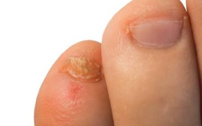 Arthritis psoriatica